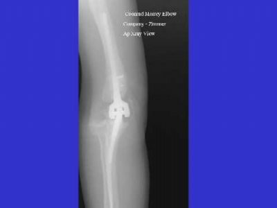 Coonrad-Morrey Total Elbow Prosthesis (Implant 148)